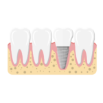 Dental Implants.